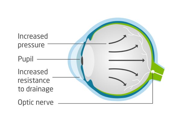 A diagram of an eye ball and various flows from pressure to the optical nerves.
